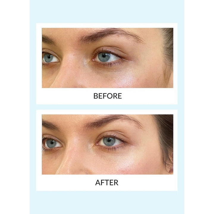 Eye Therapy Patches & Case