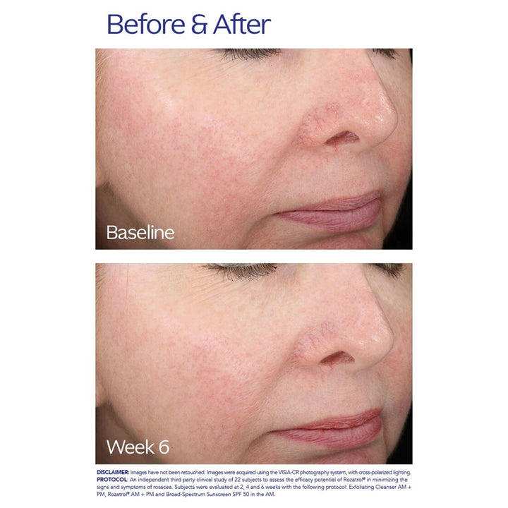 ZOSKIN-ROZATROL 50ML